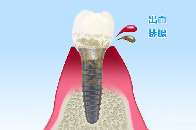 インプラント歯周炎