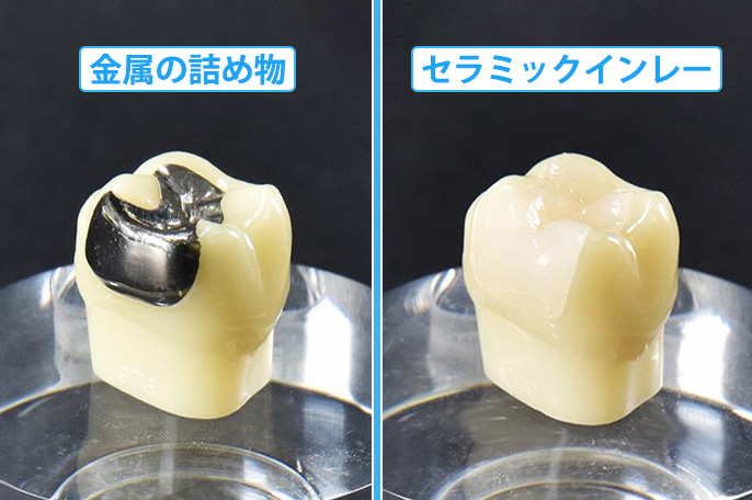 金属の詰め物・被せ物を白い歯にしませんか