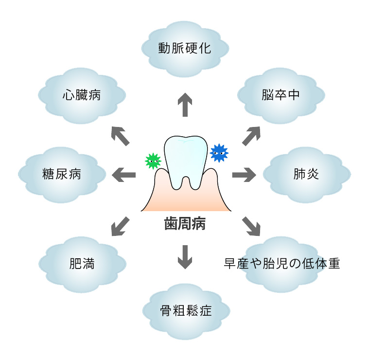 歯周病は全身の病気を引き起こす疾患です